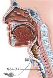 PROCEDURE TRACHEO STOMIA